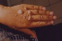 Kézfej HPV okozta szemölcsei Kézfej HPV okozta szemölcsei