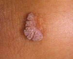 HPV fertőzés okozta karfiolszerű bőrelváltozás