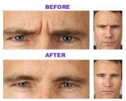 Férfi arc botox-kezelés előtt és után
