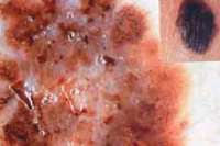 melanoma video dermatoszkópos képe