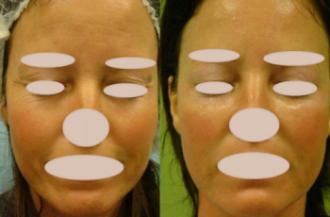 Teljes arc+ szem környékének bőrfeszesítése: kezelések előtt és után