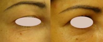 Alsó-felső szemhéj fiataltítása 1. kezelés előtt és után 2 hónappal/ További képek cikk alatt!
