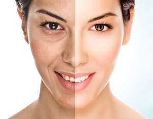 Az arc volumenpótlása, fiatalítása sajátzsír átültetéssel (Lipofilling) - photoshop Az arc volumenpótlása, fiatalítása sajátzsír átültetéssel (Lipofilling) - photoshop
