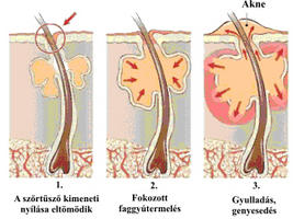 Akne kialakulásának folyamata