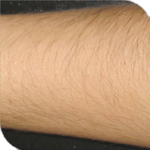 Epilfree kezelés előtt Epilfree kezelés előtt