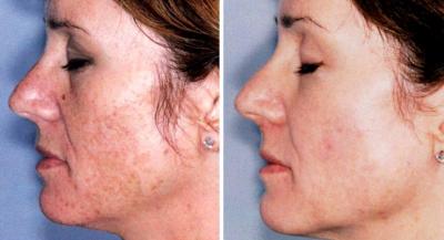 Erősen pigmentált arcbőr ELOS kezelés előtt, majd az 5. alkalom után