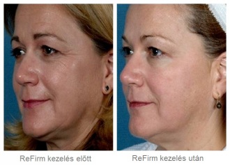 3 ReFirm arcfeszesítő kezelés eredményessége