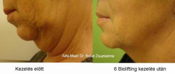 Biolifting arc-tokafeszesítés előtt és a 6. alkalom után/ Dr. Kolat Zsuzsanna