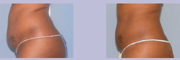 6, 5 cm haskörfogat csökkenés 3 Ultrashape kezelés előtt és után / Dr. Chris Inglefield, UK