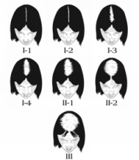 androgen alopecia androgen alopecia