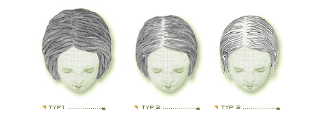 diffúz alopecia