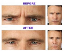 Férfi arc botox-kezelés előtt és után Férfi arc botox-kezelés előtt és után