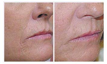 Matisse arcfiatalítás / Dr. Derm Matisse arcfiatalítás / Dr. Derm