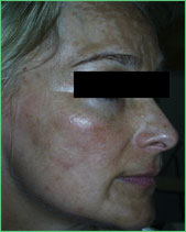Fotorejuvenáció most, vagy soha! 5.kép Fotorejuvenáció most, vagy soha! 5.kép