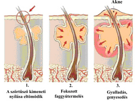 fejbőr psoriasis alternatív kezelés