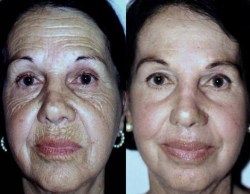 A fenolos mélyhámlasztás igazi arcfiatalodáshoz vezet, de a kezelés nem rizikómentes.