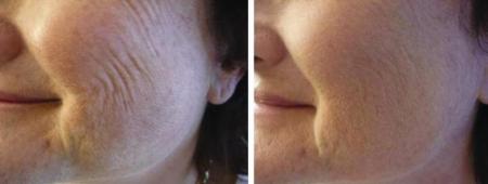 Orca feltöltése 40+ éves hölgy arcán / Stylage- PROMEDICS Orca feltöltése 40+ éves hölgy arcán / Stylage- PROMEDICS