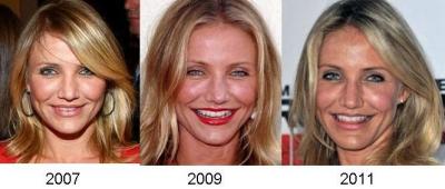 Cameron Diaz orra már sokkal egyenesebb   1.kép