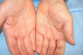 kontakt dermatitisz kontakt dermatitisz