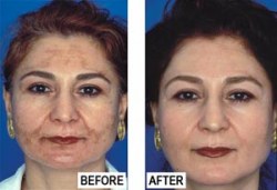 Hiperpigmentált (melasma) arcbőr kezelés előtt és után Hiperpigmentált (melasma) arcbőr kezelés előtt és után