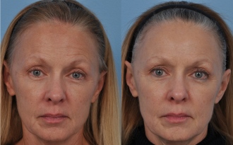 Teljes arc feszesítése PELLEVÉ eljárással: eredmény a 2. kezelés után 60 nappal 