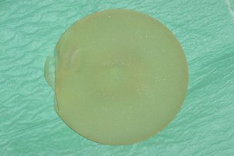 Ruptúrált (kiszkadt) PIP implantátum Ruptúrált (kiszkadt) PIP implantátum
