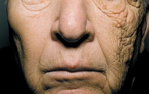 69 éves férfi félodalas fokozott bőröregedése/ photoaging