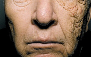 69 éves férfi félodalas fokozott bőröregedése/ photoaging 69 éves férfi félodalas fokozott bőröregedése/ photoaging