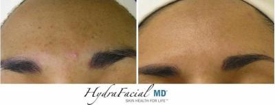 HydraFacial kezelés eredménye napkárosodott bőr esetén HydraFacial kezelés eredménye napkárosodott bőr esetén
