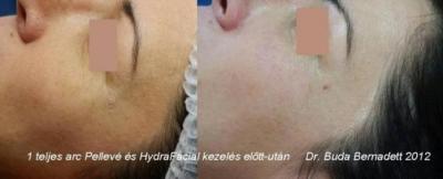 1 teljes arc HydraFacial és Pelleve kezelés után