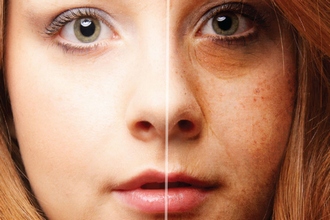 A szolárium UVA sugarai fokozzák a bőr öregedését és hyperpigmentációt okozhatnak
