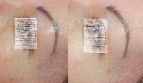 3 Pellevé + Hydrafacial kezelés sorozat előtt és után 3 Pellevé + Hydrafacial kezelés sorozat előtt és után