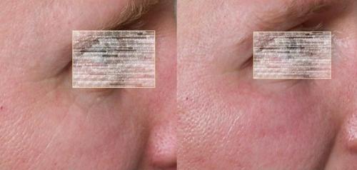 3 Pellevé + Hydrafacial kezelés sorozat előtt és után 3 Pellevé + Hydrafacial kezelés sorozat előtt és után