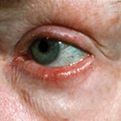 Árpa, ekcéma, csüngés - a szemhéj betegségei