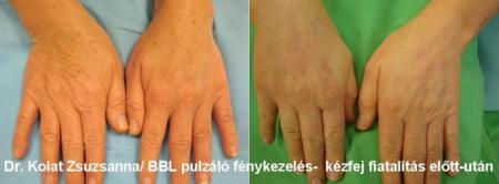 Kézfej fiatalítás eredményessége/ BBL fotorejuvenáció/ Dr. Kolat Zsuzsanna 