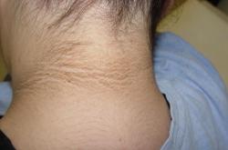 Acanthosis nigricans- PCOS jellemző bőrtünete