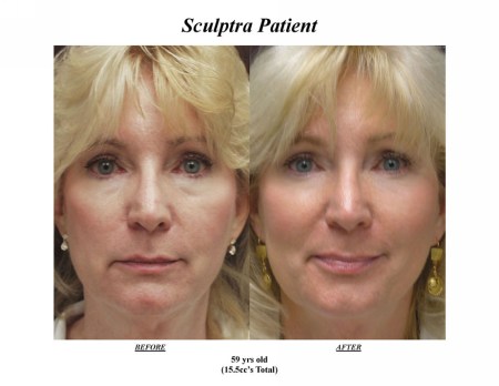 59 éves nő páciens arcfiatalodásának eredménye  SCULPTRA hatására