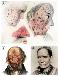  Dr. Robert Willan bőrgyógyász 1817-es kiadású könyvében található rosaceas arcok