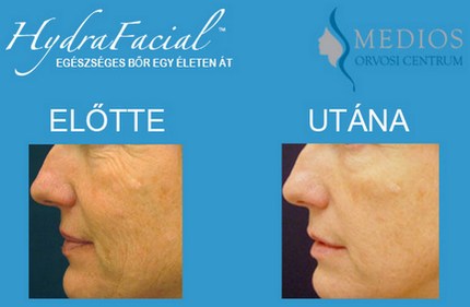 HydraFacial kezelés előtt-után/ 4 alk./ HydraFacial TM