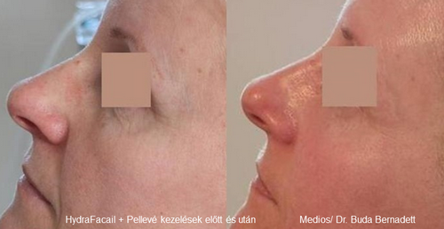 Pellevé + HadryFacial teljes arckezelés előtt és a 3. kezelés után/ Dr. Buda Bernadett Pellevé + HadryFacial teljes arckezelés előtt és a 3. kezelés után/ Dr. Buda Bernadett