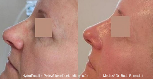 Pellevé + HadryFacial teljes arckezelés előtt és a 3. kezelés után/ Dr. Buda Bernadett