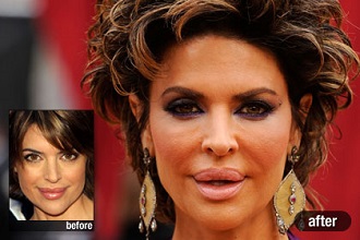 Lisa Rinna felduzzasztott ajka és túlfeszített arcbőre a Los Angeles-i rossz példa Lisa Rinna felduzzasztott ajka és túlfeszített arcbőre a Los Angeles-i rossz példa