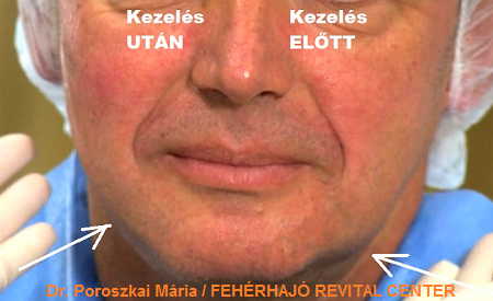 COG bioszálas bevezetése UTÁN közvetlenül és a kezelés ELŐTTI arcfél/ Dr. Poroszaki Mária, Fehérhajó Revital Center
