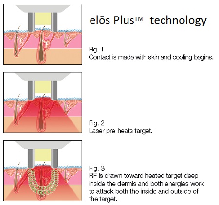 Teljes arcfiatalítás az Elos Plus orvos-esztétikai rendszerrel 2.kép