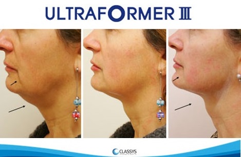 A legújabb orvosi HIFU arc és a test feszesítésére is – ULTRAFORMER III.  3.kép
