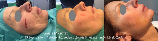 Arcfiatalítás és rejuvenálás Goisis Microfat saját zsír feltöltéssel / Dr. László Zsolt