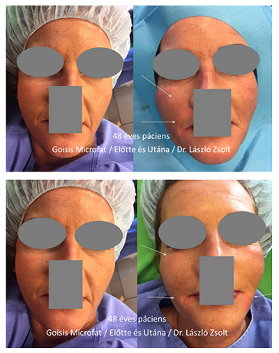 Arcfiatalítás Goisis Microfat saját zsír feltöltéssel/ Dr. László Zsolt Arcfiatalítás Goisis Microfat saját zsír feltöltéssel/ Dr. László Zsolt