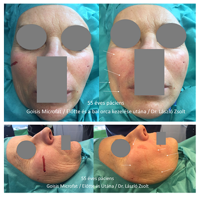 Arcszobrászat Goisis Microfat saját zsír feltöltéssel/ Dr. László Zsolt Arcszobrászat Goisis Microfat saját zsír feltöltéssel/ Dr. László Zsolt
