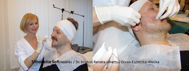 Dr. Kriston Renáta kijelöli Lakatos Márk arcán a Silhouette szálak vonalát, majd Mark arca kezelés közben Dr. Kriston Renáta kijelöli Lakatos Márk arcán a Silhouette szálak vonalát, majd Mark arca kezelés közben