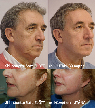 Elvárható eredmények Silhouette Soft Lifting után azonnal és1 hónap után Elvárható eredmények Silhouette Soft Lifting után azonnal és1 hónap után